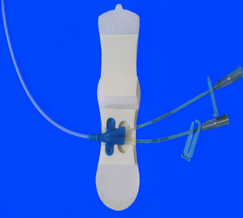 導(dǎo)管固定圖片/導(dǎo)管固定樣板圖 (2)