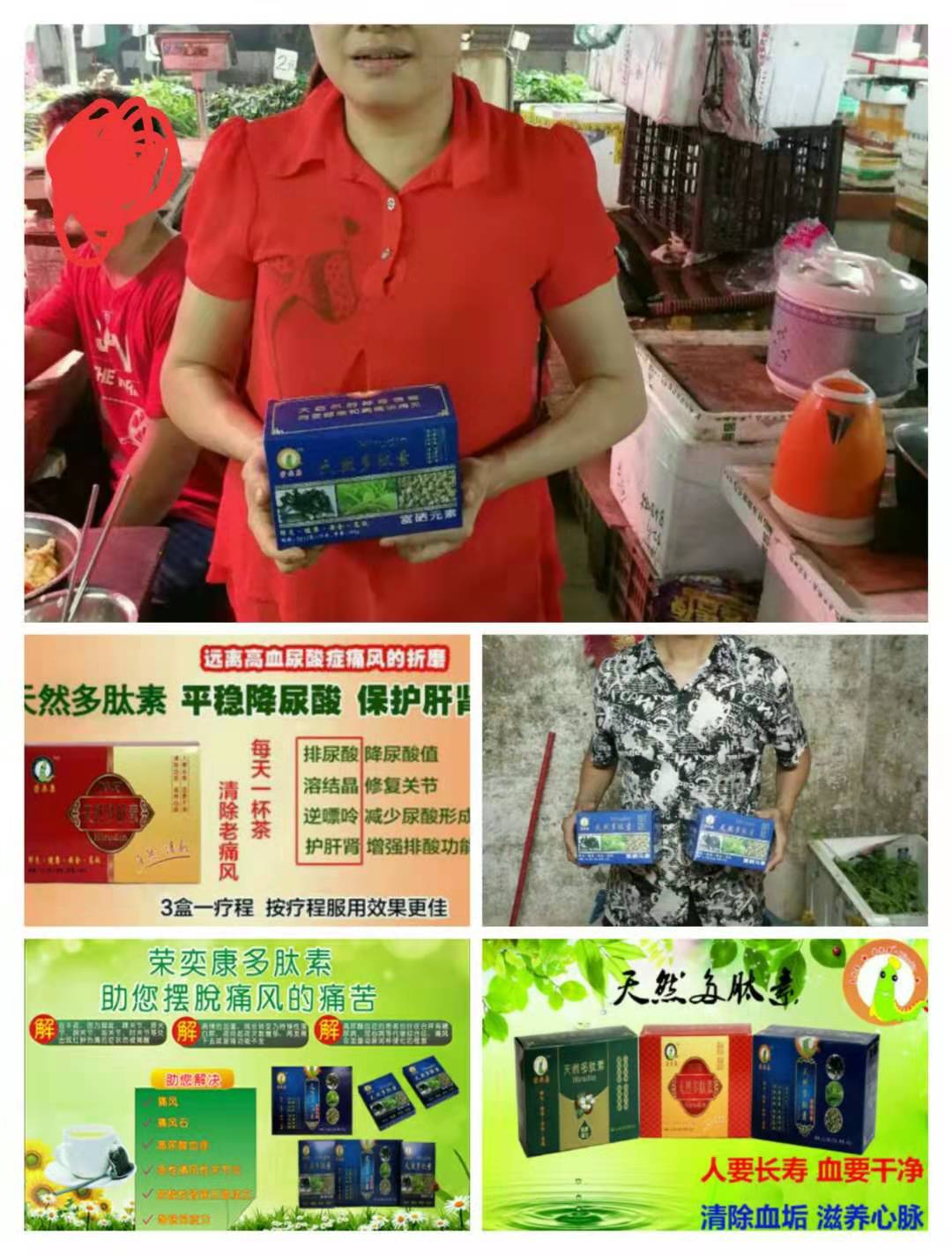 痛風(fēng)圖片/痛風(fēng)樣板圖 (4)