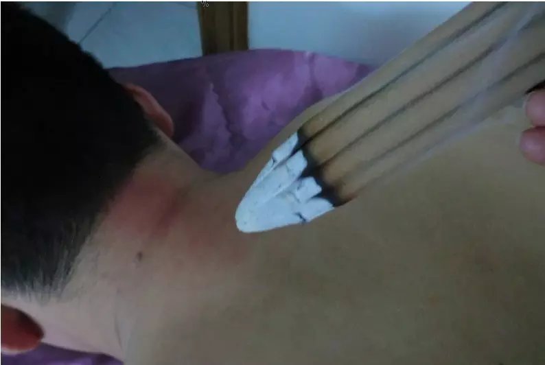 火蓮香灸廠家直銷九宮火蓮香灸批發(fā)通天灸蓮香300
