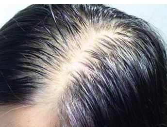 重慶植發(fā)多少錢？ 重慶哪里有不錯的植發(fā)*？