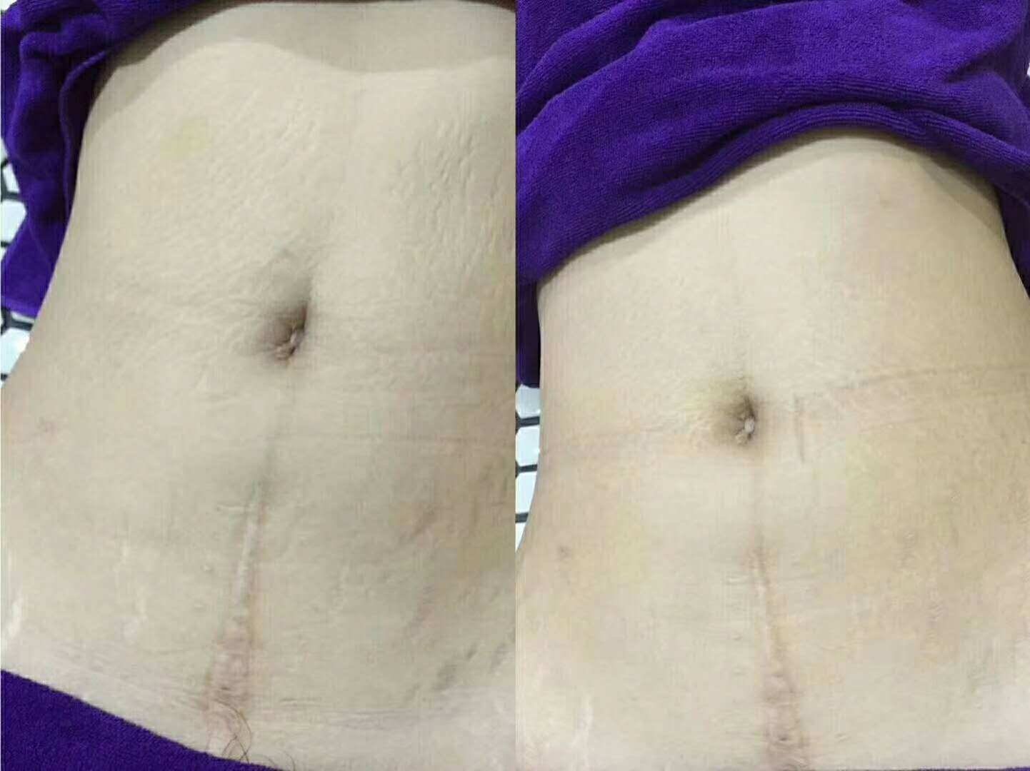 武漢*哪里修復(fù)好—武漢紋管家