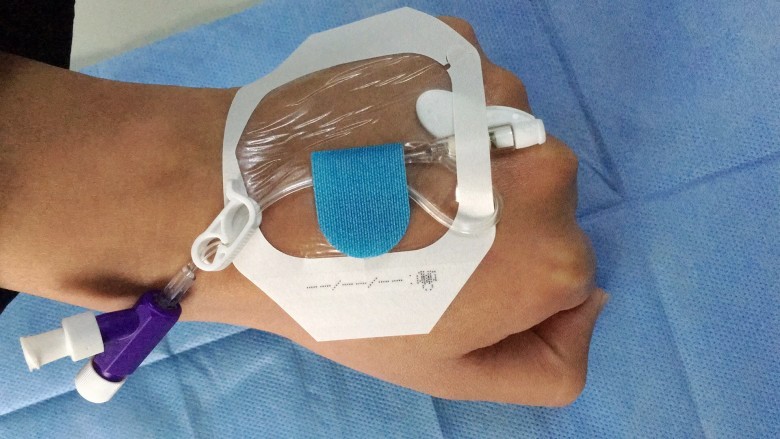 一次性體表導管固定裝置,導管固定器 體表導管固定裝置,留置針固定裝置