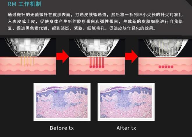 Gentlo射頻微針等離子美容儀